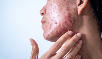 Accutane