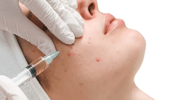 Acne treatment