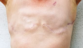 Bilateral Mastectomy