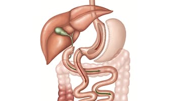 Biliopancreatic Diversion