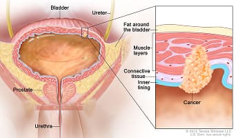 Bladder Cancer