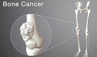 Bone Cancer
