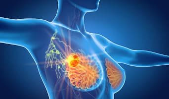 Breast Cancer