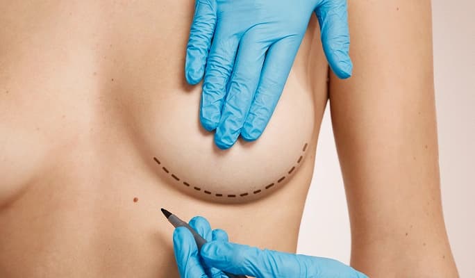 Breast Lift (Mastopexy)