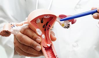 Cervical Cancer