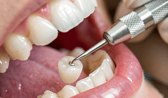 Dental Crown