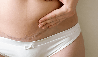 Diastasis