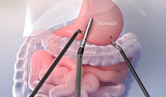 Duodenal Switch Surgery