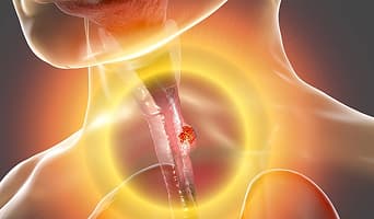 Esophageal Cancer Treatment