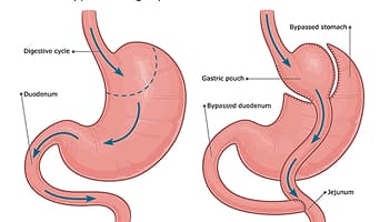 Gastric Bypass Revision