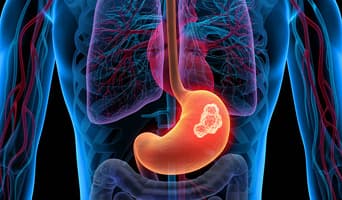 Gastric Cancer Treatment