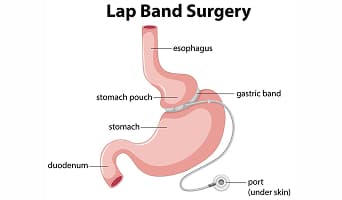 Lap Band Surgery