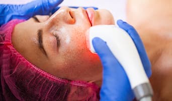 Laser Skin Resurfacing
