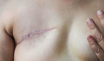 Mastectomy