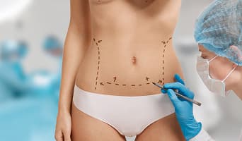 Mini Tummy Tuck