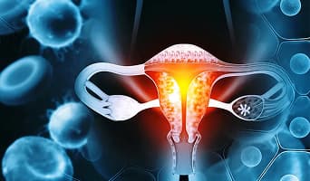 Ovarian Cancer