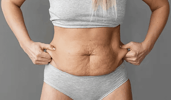 Panniculectomy Surgery