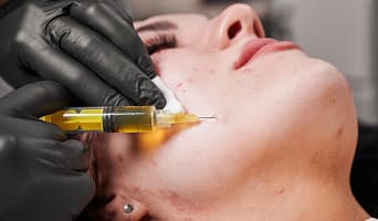 PRP Skin Treatment
