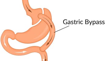 Roux en Y Gastric Bypass
