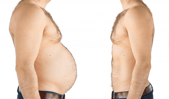 Sleeve Gastrectomy