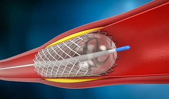 Vascular Stenting