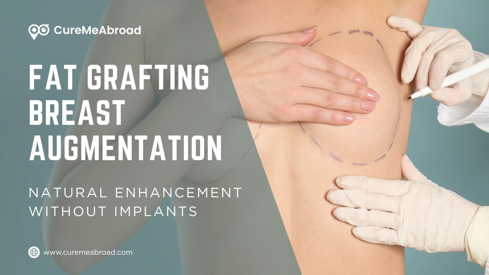 Fat Grafting Breast Augmentation: Natural Enhancement Without Implants