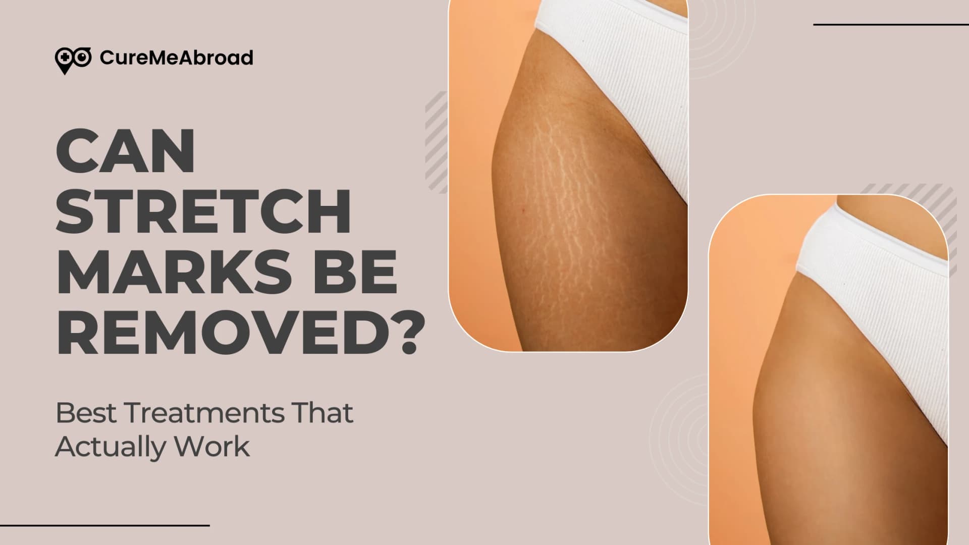 Can Stretch Marks Be Removed? Best Treatments That Actually Work