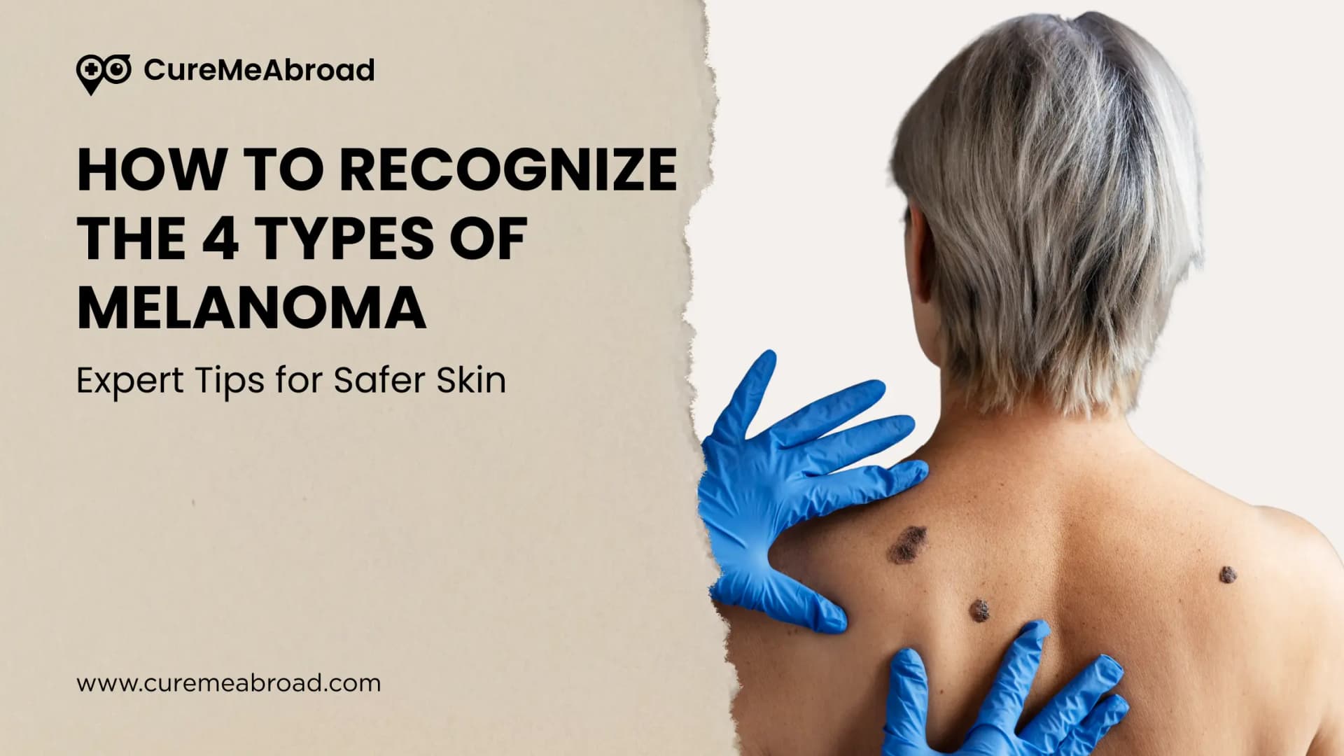 How to Recognize the 4 Types of Melanoma: Expert Tips for Safer Skin