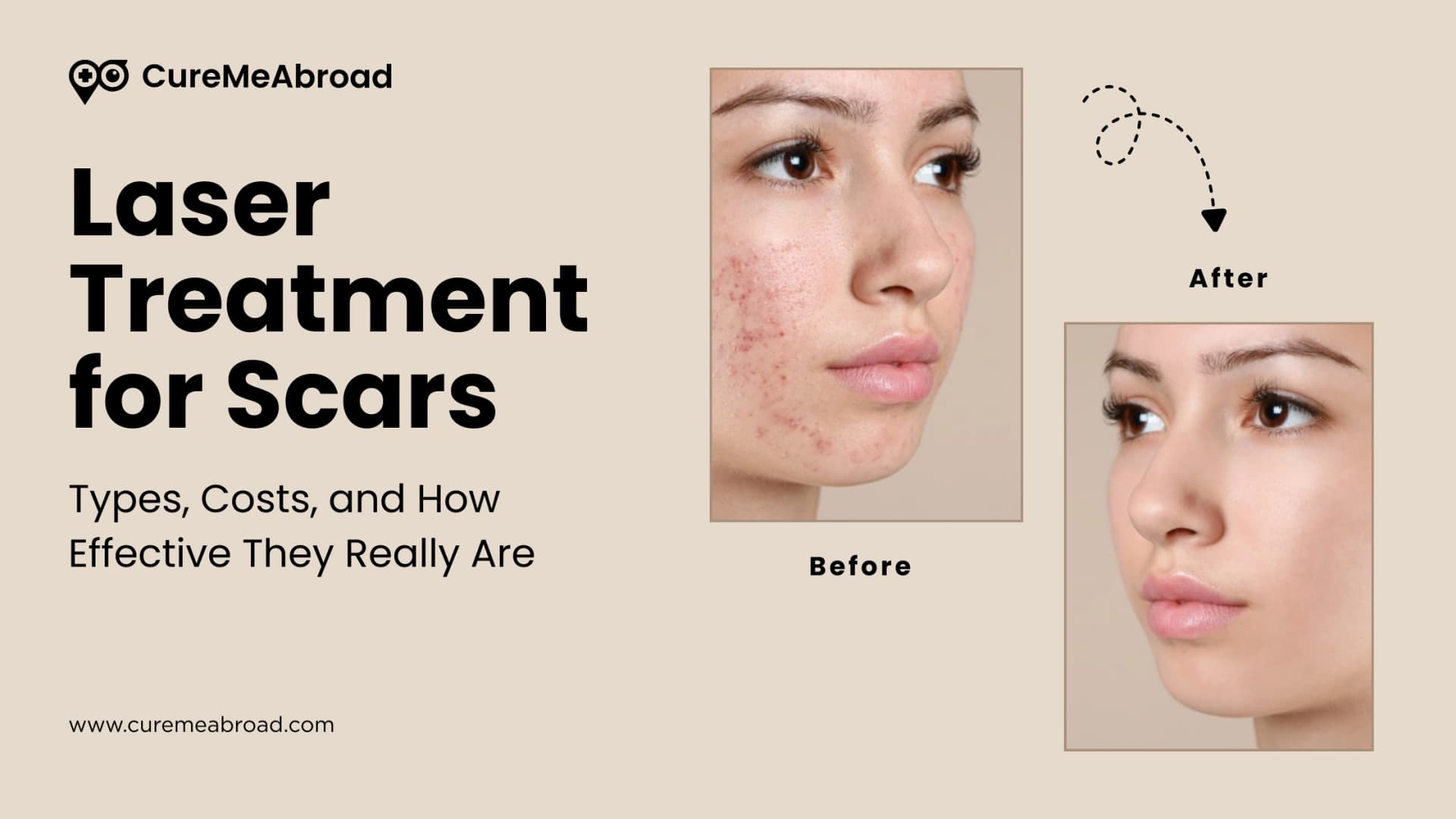 Laser Treatment for Scars: Types, Costs, and How Effective They Really Are