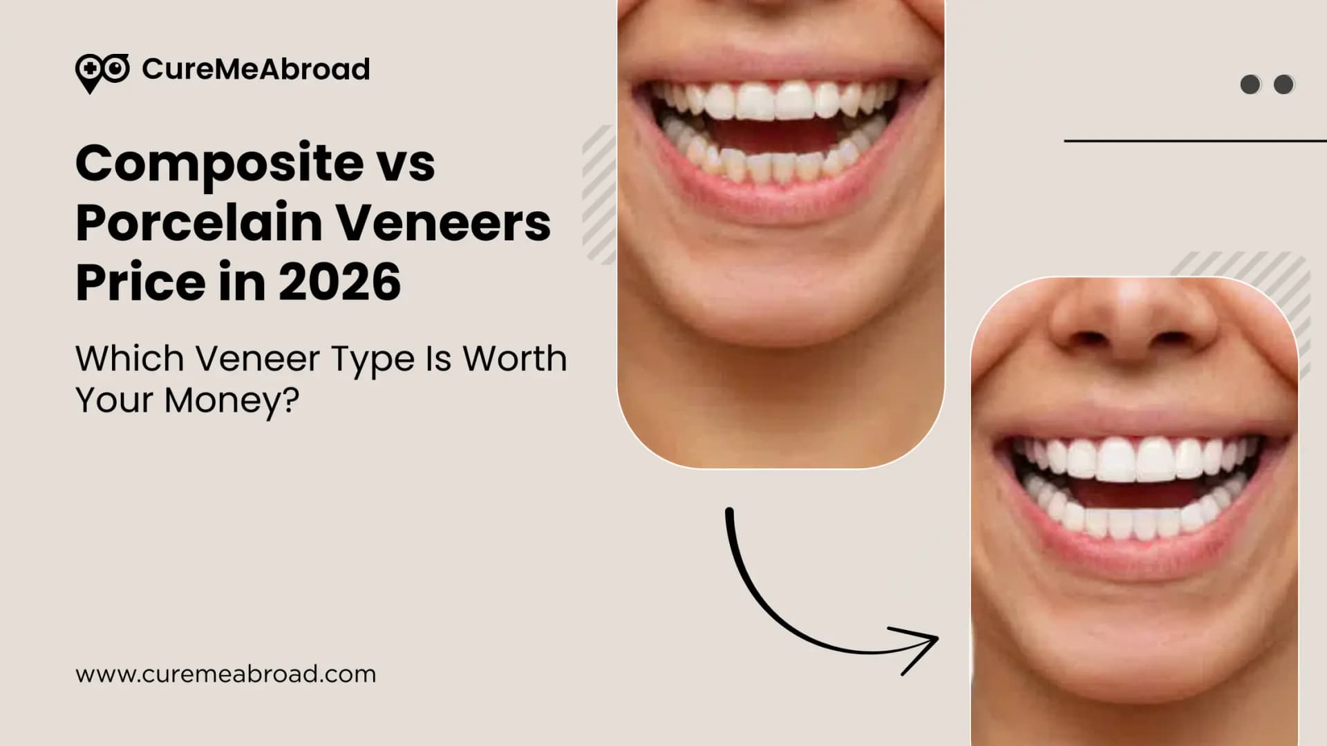 Composite vs Porcelain Veneers Price in 2026: Which Veneer Type Is Worth Your Money?