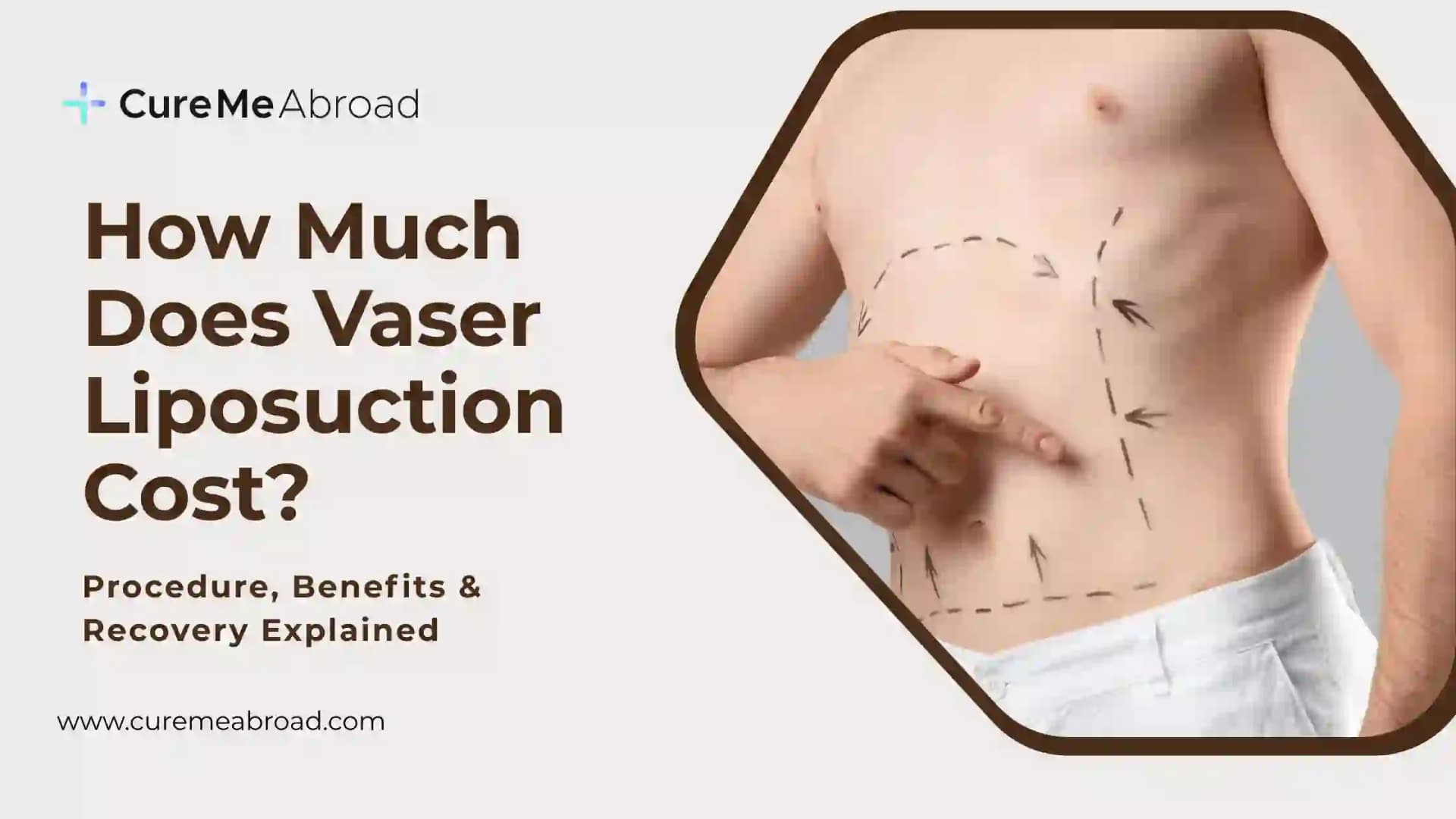 VASER Liposuction Cost in 2026: The Complete Guide to What You'll Actually Pay