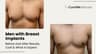 Men with Breast Implants: Before and After Results, Cost & What to Expect