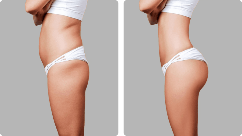 BBL (Brazilian Butt Lift) before and after