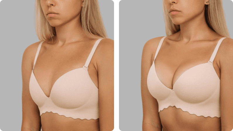 Breast Augmentation before and after