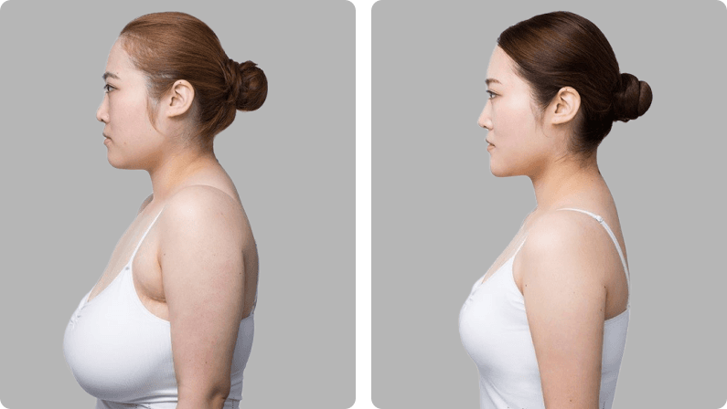 Breast Reduction before and after
