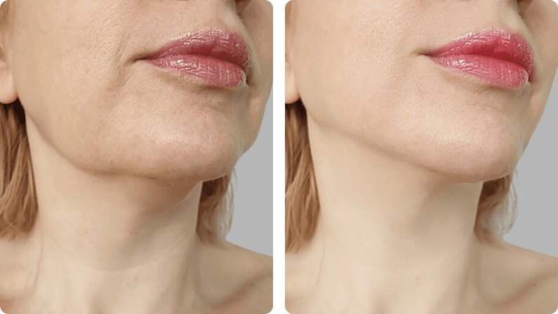 Chin Liposuction before and after