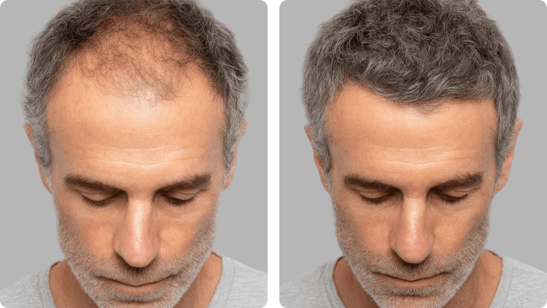 Hair Restoration and Transplantation before and after