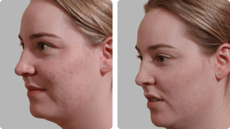 Laser Skin Resurfacing before and after