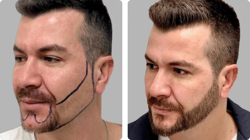 Moustache and Beard Transplant before and after