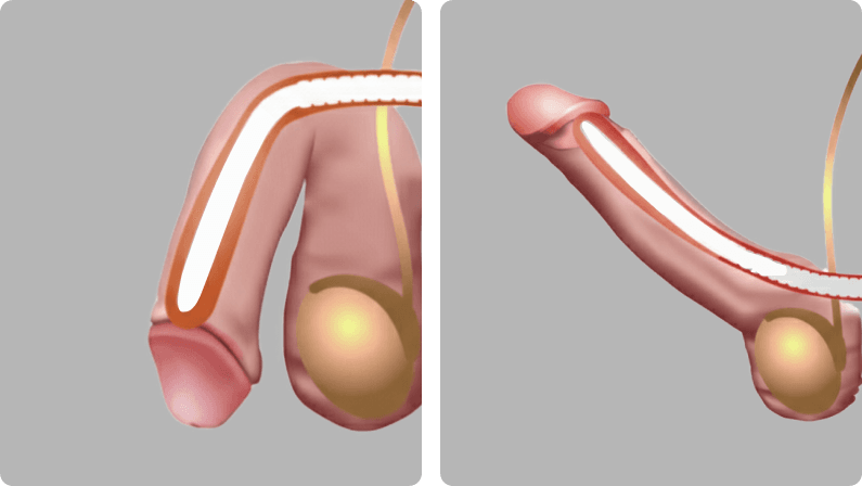 Penile Augmentation before and after