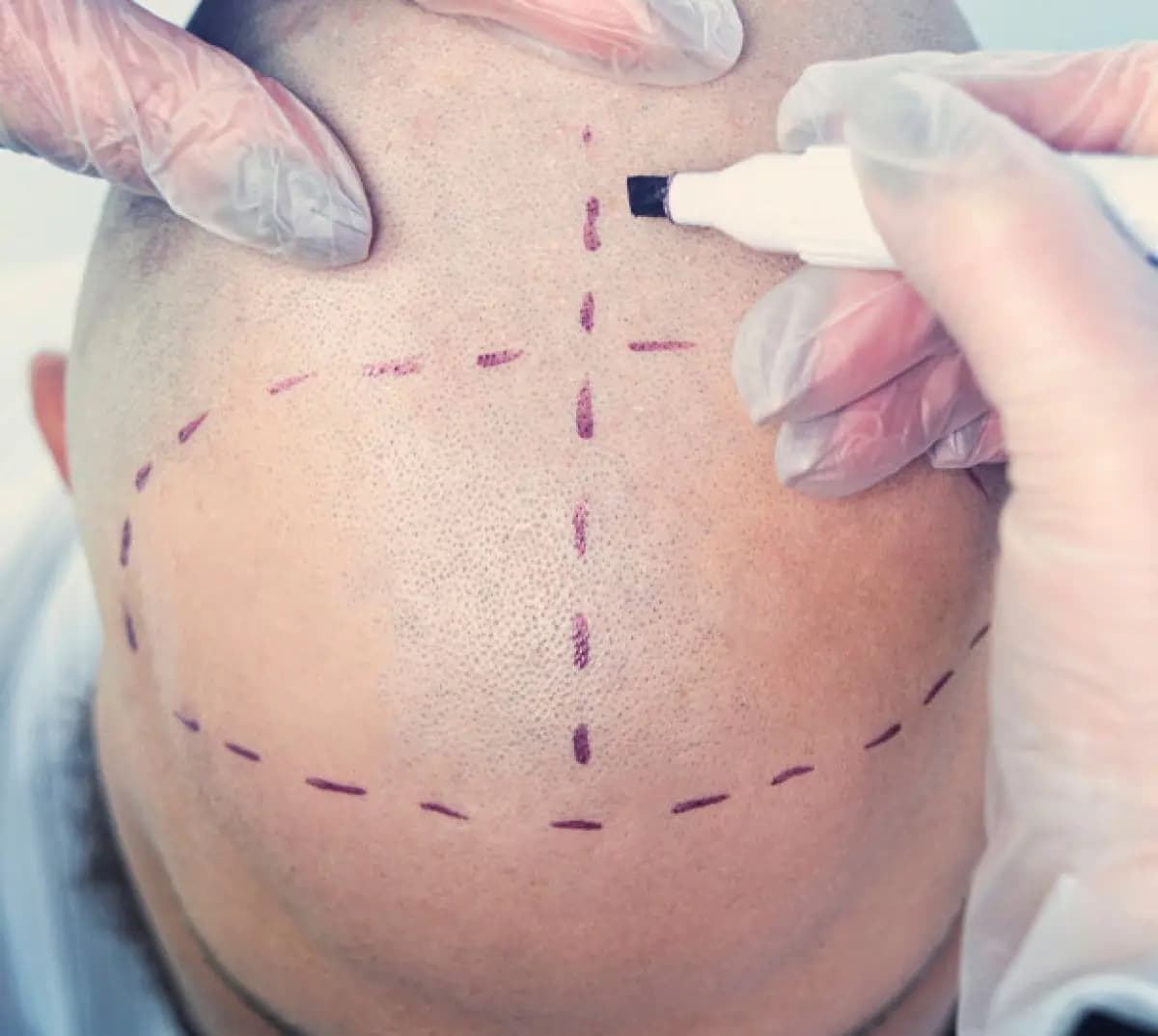 NextGen- Hair Transplants - Image 3