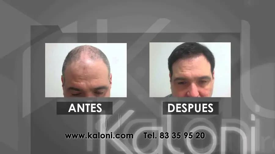 Kaloni Monterrey - Image 3