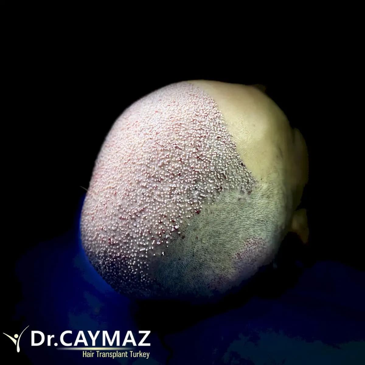Dr. Erkam Caymaz's Hair Upload Clinic - Image 3