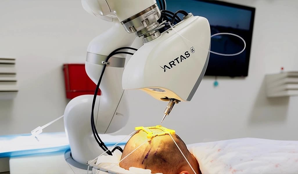 ARTAS Robotic Hair Transplant