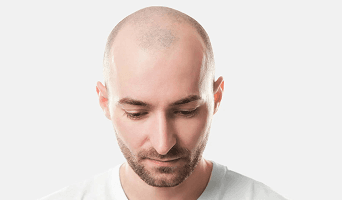 Direct Hair Implantation (DHI)