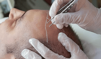 FUE Hair Transplant