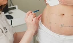 High Definition Liposuction (VASER Lipo)