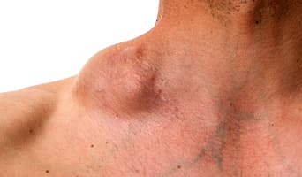 Non-Hodgkin Lymphoma (NHL)