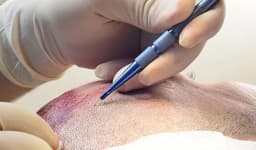 Sapphire FUE Hair Transplant