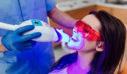 Teeth Whitening / Teeth Bleaching